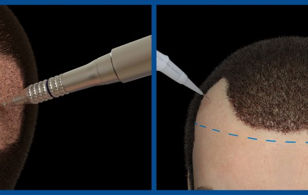 trapianto-capelli-3D