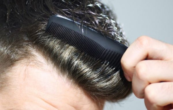 Caduta capelli Uomo