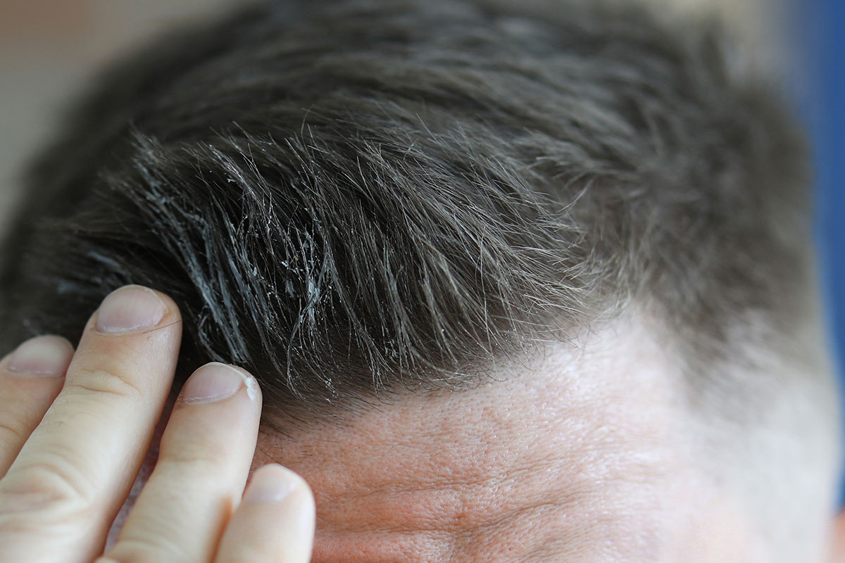 il gel può far cadere i capelli?