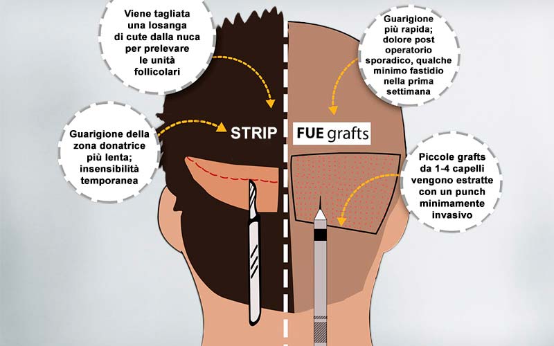 Trapianto di capelli con tecnica FUE Strip