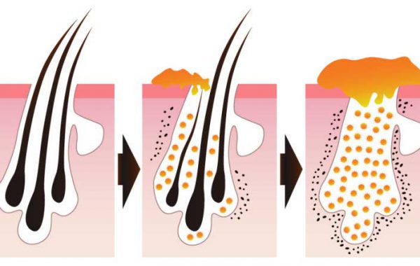 Le ghiandole sebacee e il cuoio capelluto