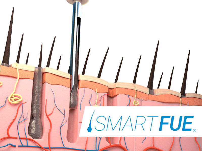 calvizie-precoce-soluzioni-smart-fue