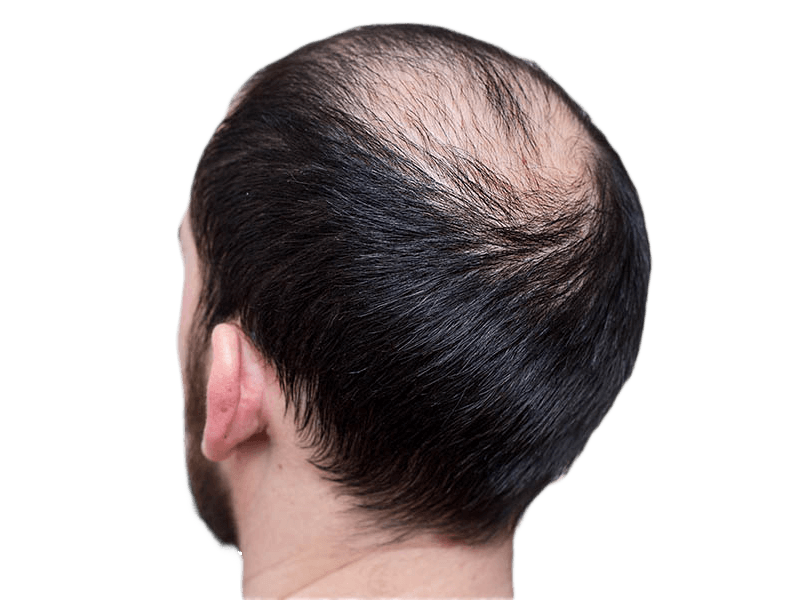 Cause caduta capelli uomo: alopecia androgenetica