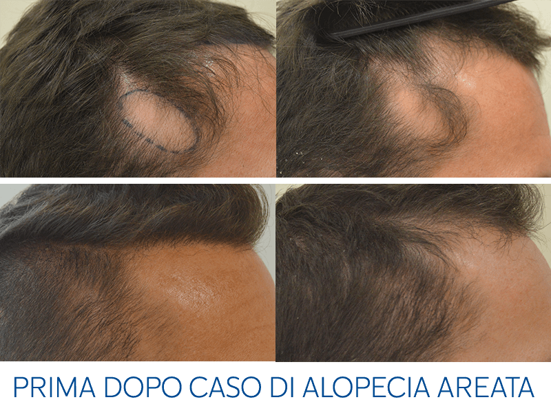 risultati del trattamento di alopecia areata