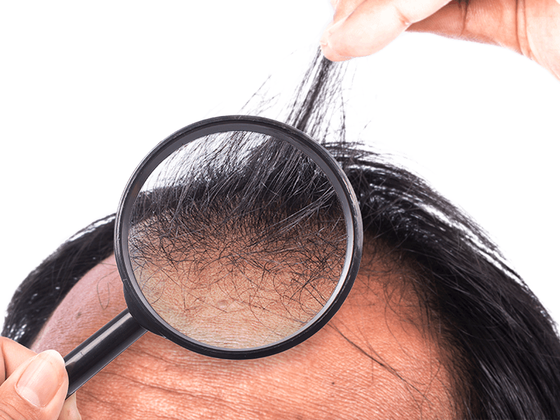 cause-caduta-capelli-alopecia-areata-come-accorgersene