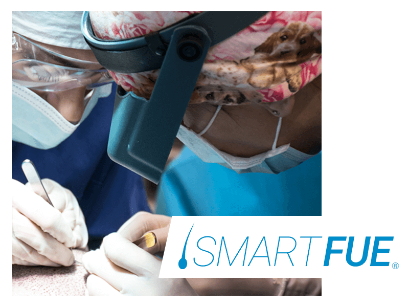 cause-caduta-capelli-alopecia-trazione-soluzioni-smart-fue