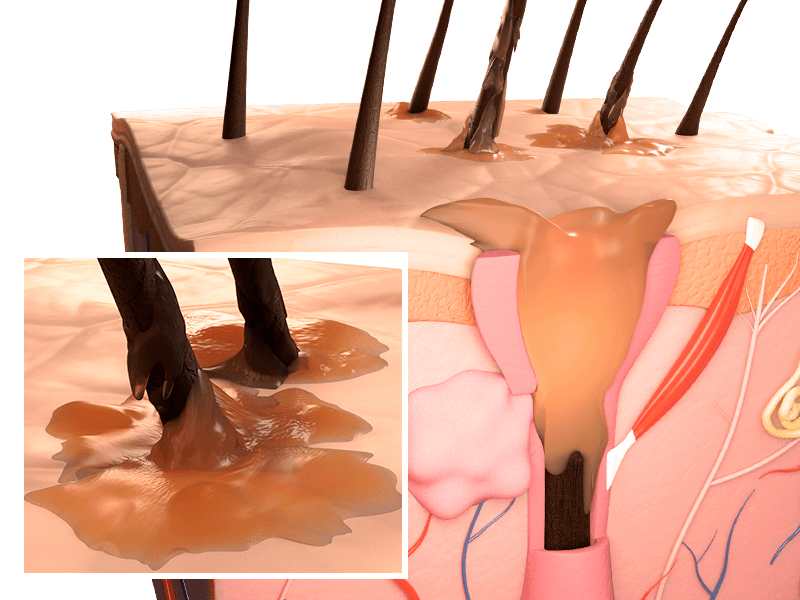 Problemi del cuoio capelluto: la seborrea