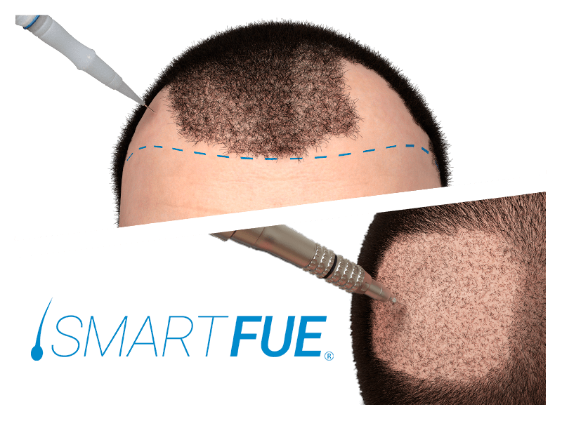 rimedi caduta capelli: il trapianto di capelli