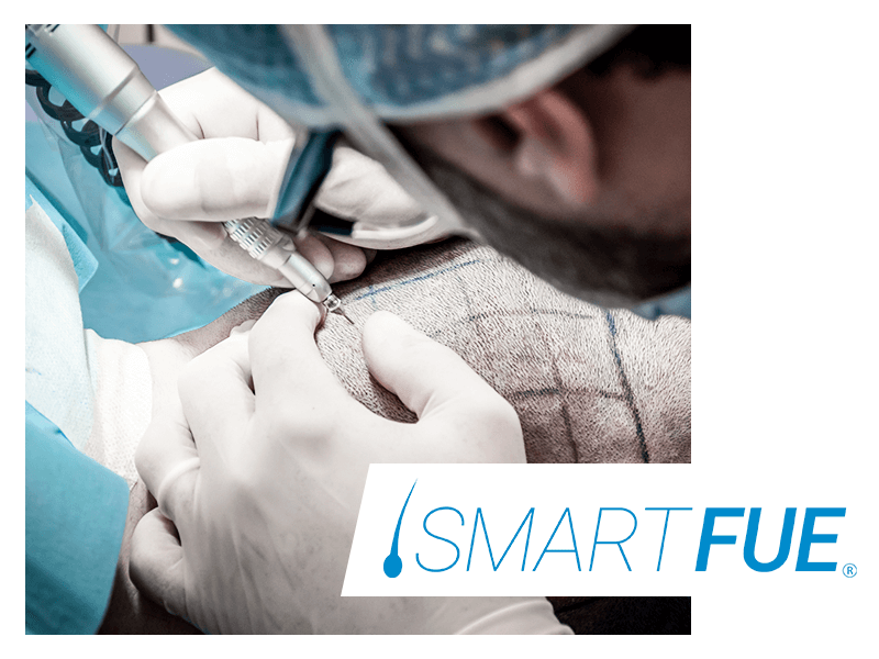 soluzioni-rimedi-caduta-capelli-smart-fue