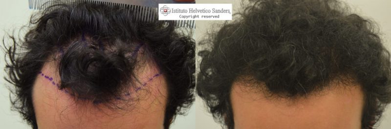 risultato trapianto con capelli ricci