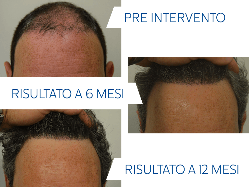 trapianto-smart-fue-come-funziona-risultati-12-mesi