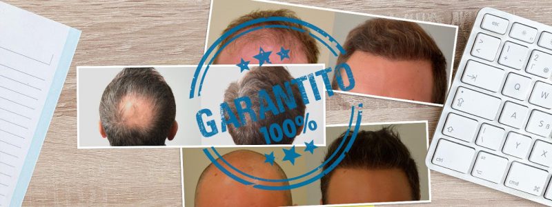 Garanzia scritta per il trapianto di capelli Smart Fue