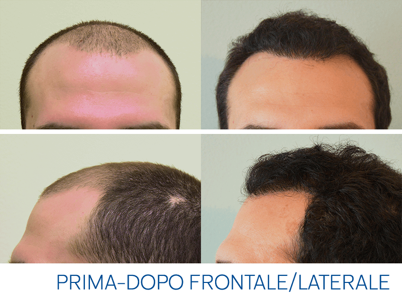 Trapianto Capelli: galleria prima e dopo l'intervento
