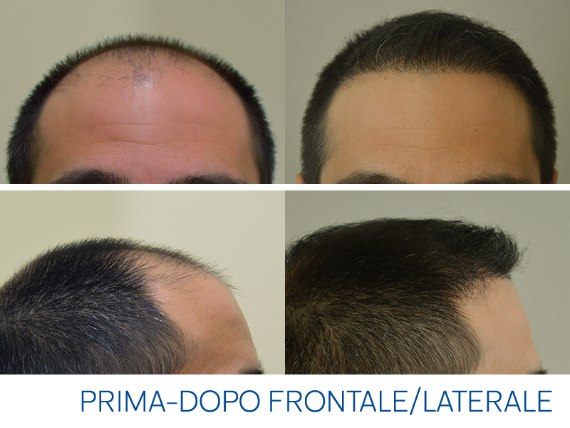 risultati e prezzi del trapianto di capelli