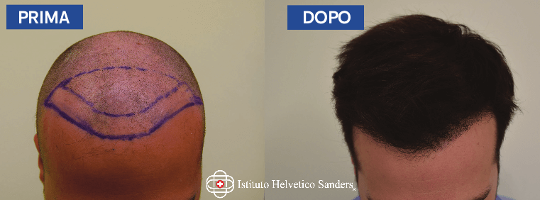 trapianto capelli Smart Fue - Istituto Helvetico Sanders