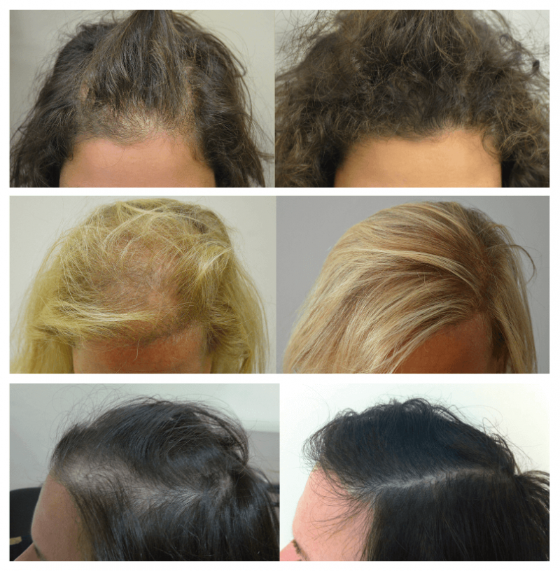 risultati autotrapianto donna