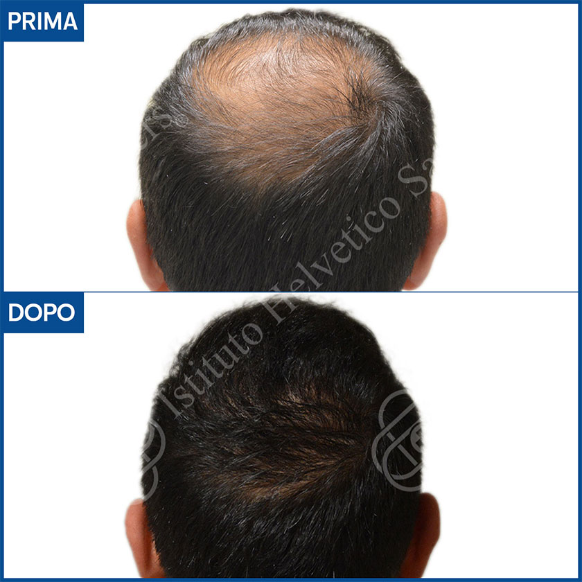 Risultato trapianto capelli vertice