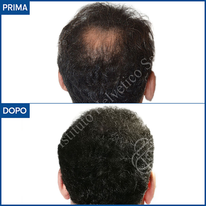 prima e dopo il trapianto capelli vertice