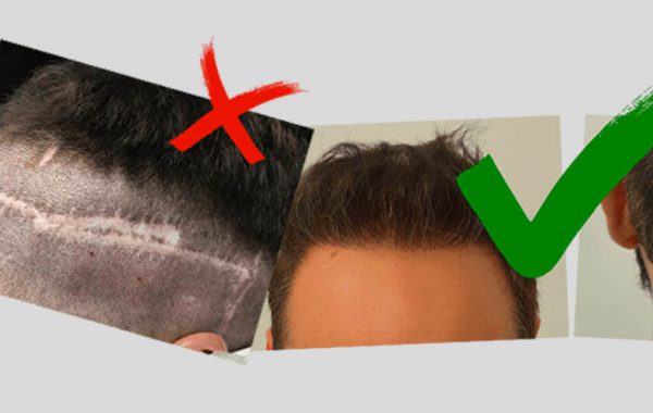 Mercato nero trapianto capelli Turchia