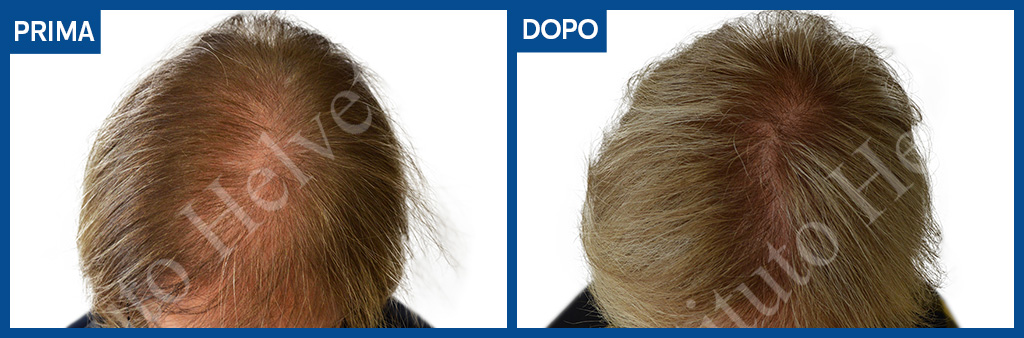 prima e dopo trapianto capelli donna