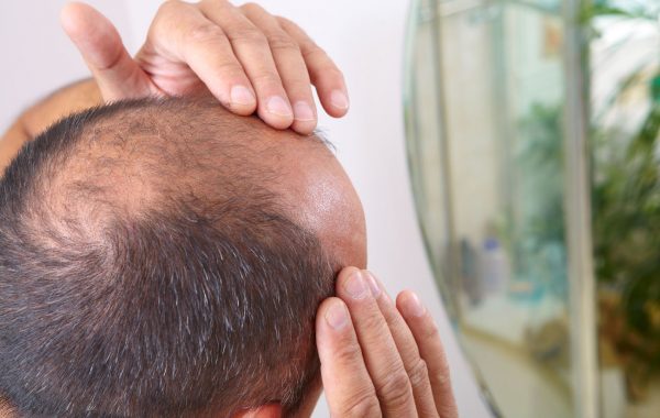 DHT e capelli, il ruolo del diidrotestosterone nella calvizie maschile