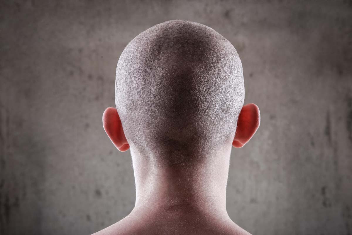 alopecia universale si guarisce