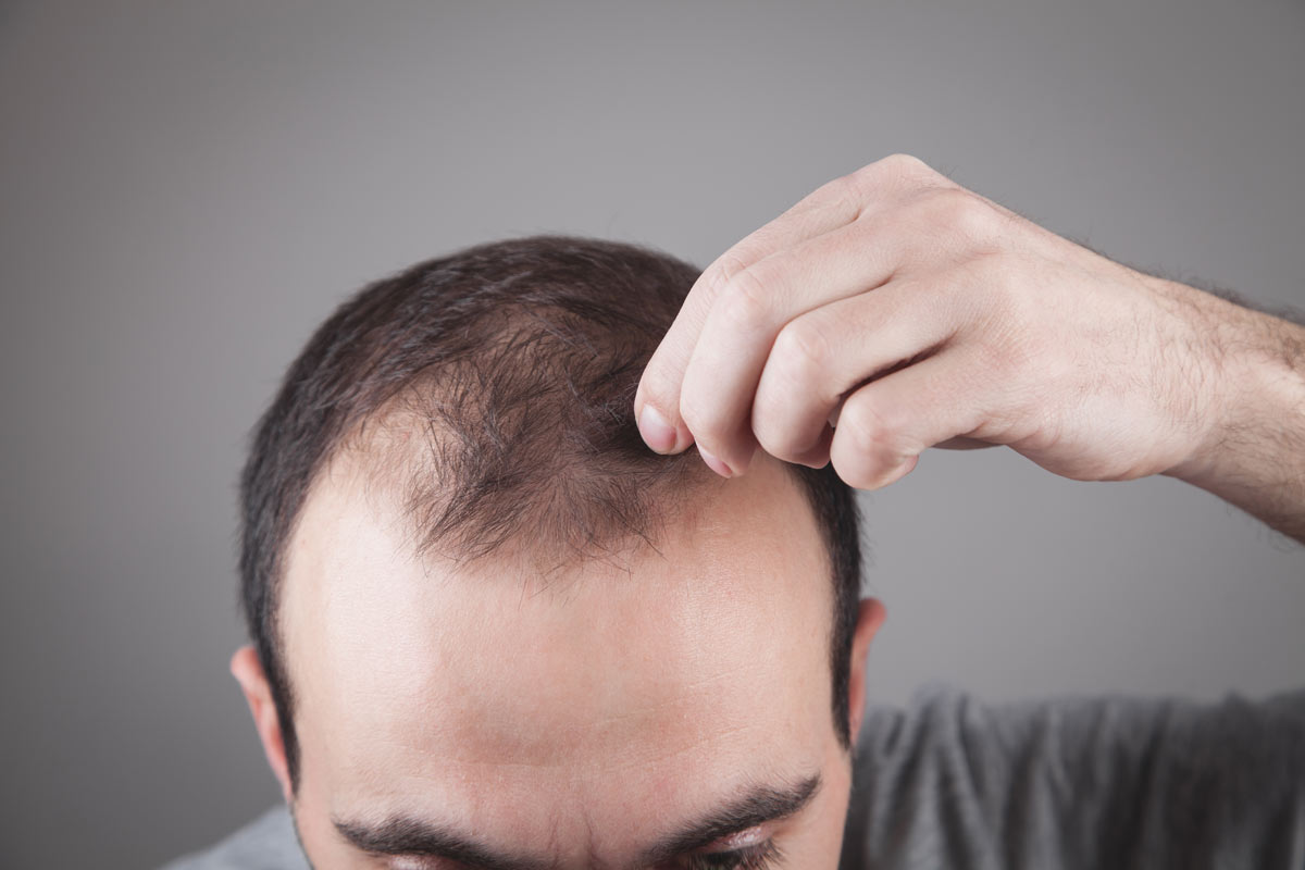 Rimedi per l'alopecia