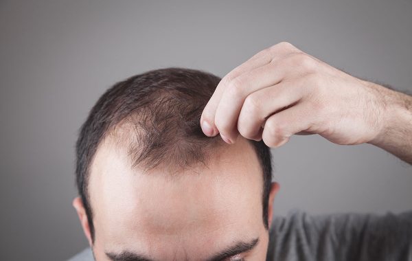 Far ricrescere i capelli persi è possibile? Cosa bisogna sapere sulla calvizie