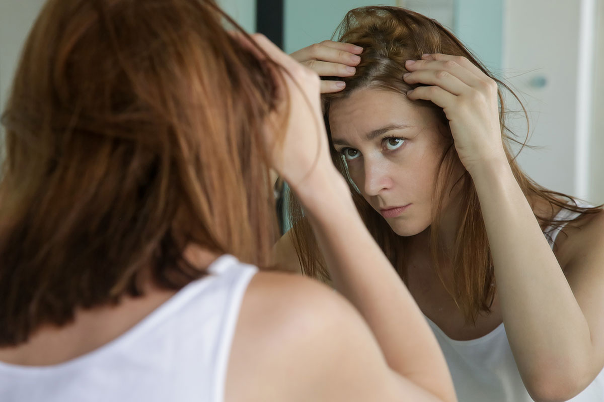 Alopecia areata femminile