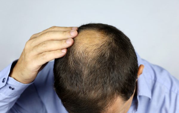 Nevralgia alla testa e dolori al cuoio capelluto, quali sono le cause?