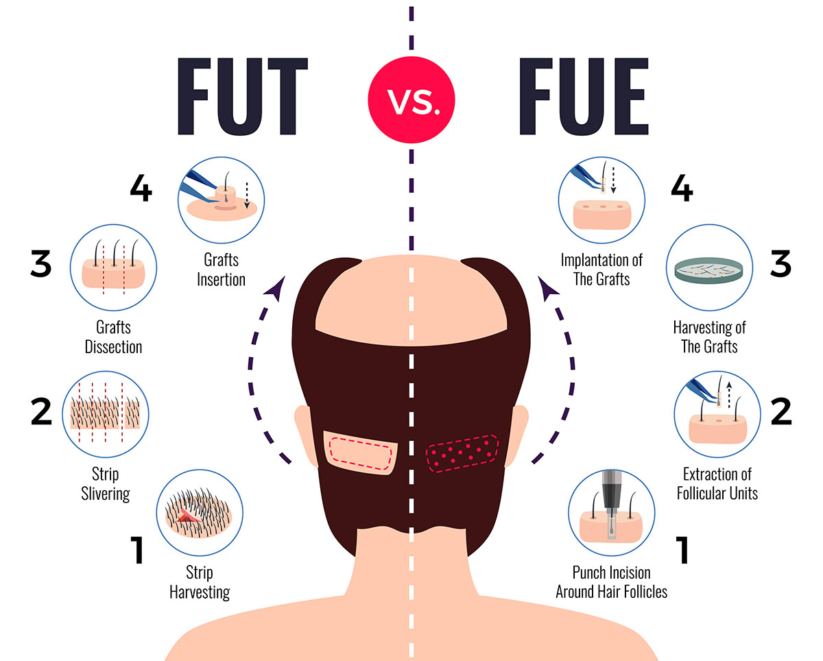 Differenze Trapianto Capelli FUT e FUE