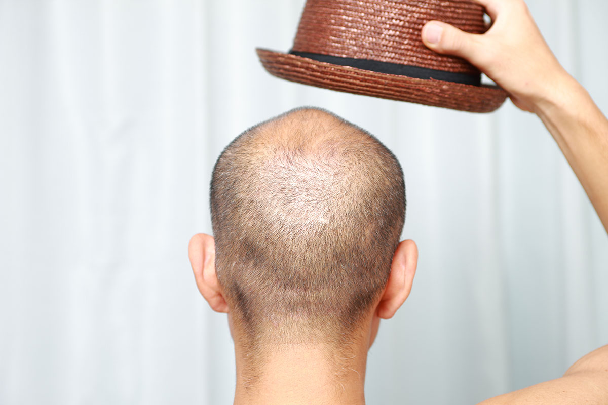 il cappello fa cadere i capelli