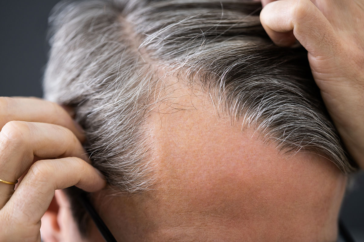 Quale vitamina manca se cadono i capelli