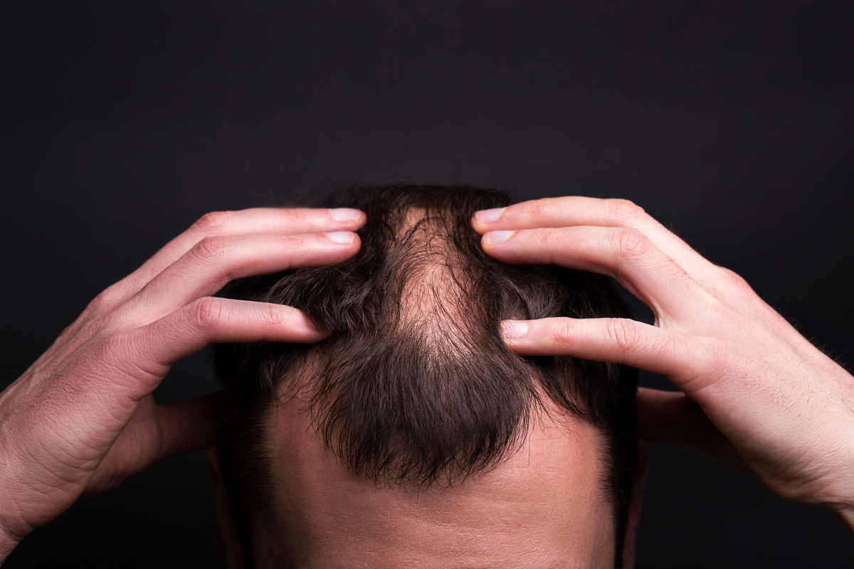 caduta capelli stagionale autunno