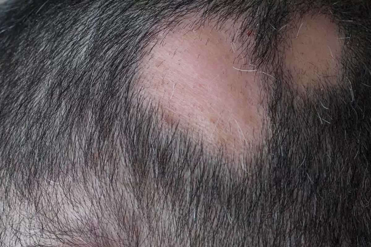 Alopecia arata cos'è