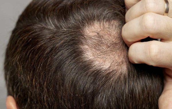 Depressione causa perdita capelli