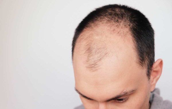 Alopecia frontoparietale: cos'è e cosa la differenzia dalle altre