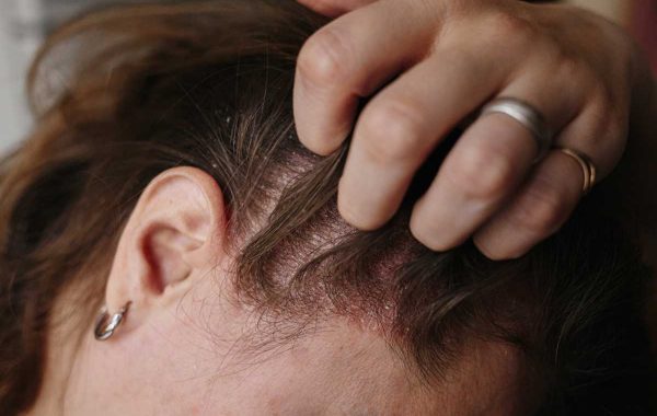 Infiammazione del cuoio capelluto, quali sono i problemi più comuni?